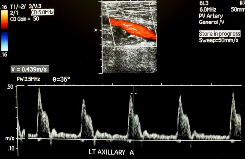 頸動脈超聲波